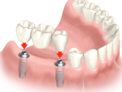 Implantes dentários múltiplos em Manaus — clínica Sanmede