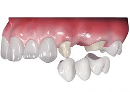 Prótese fixa sobre dente em Manaus — Sanmede