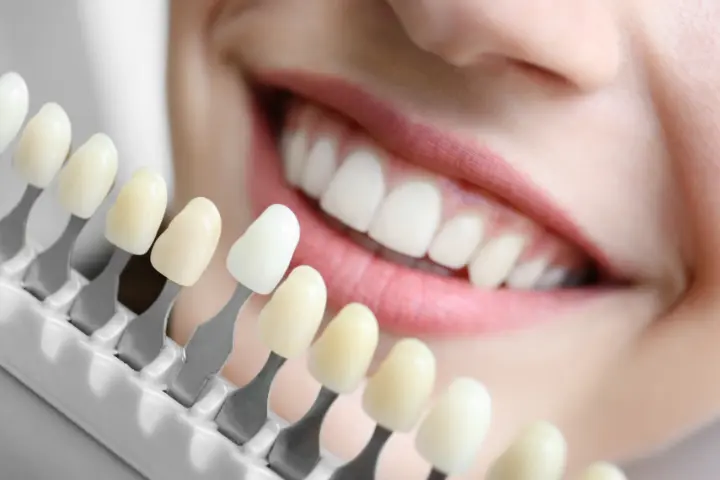 Clareamento dental em Manaus — Sanmede Clínica Odontológica
