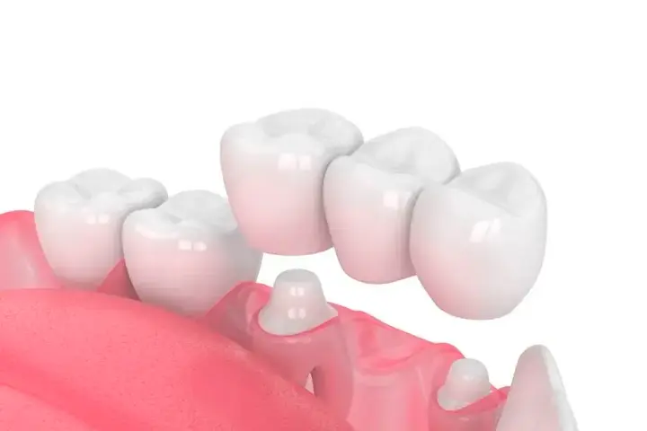 Prótese dentária em Manaus — Sanmede Clínica Odontológica