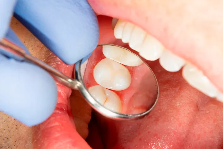 Restaurações dentárias estéticas em Manaus — Sanmede Clínica Odontológica