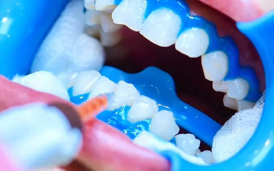 Clareamento dental em consultório em Manaus — Sanmede Clínica Odontológica Clareamento dental em consultório em Manaus — Sanmede Clínica Odontológica