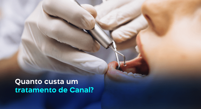 quanto-custa-tratamento-de-canal