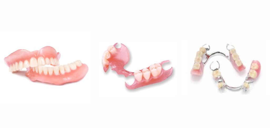 Tipos prótese dentária