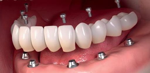 foto de protese dentaria fixa tipo protocolo