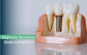 implante dentário